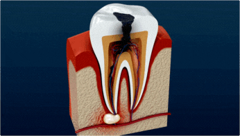 "Illustration of a tooth undergoing root canal treatment." 