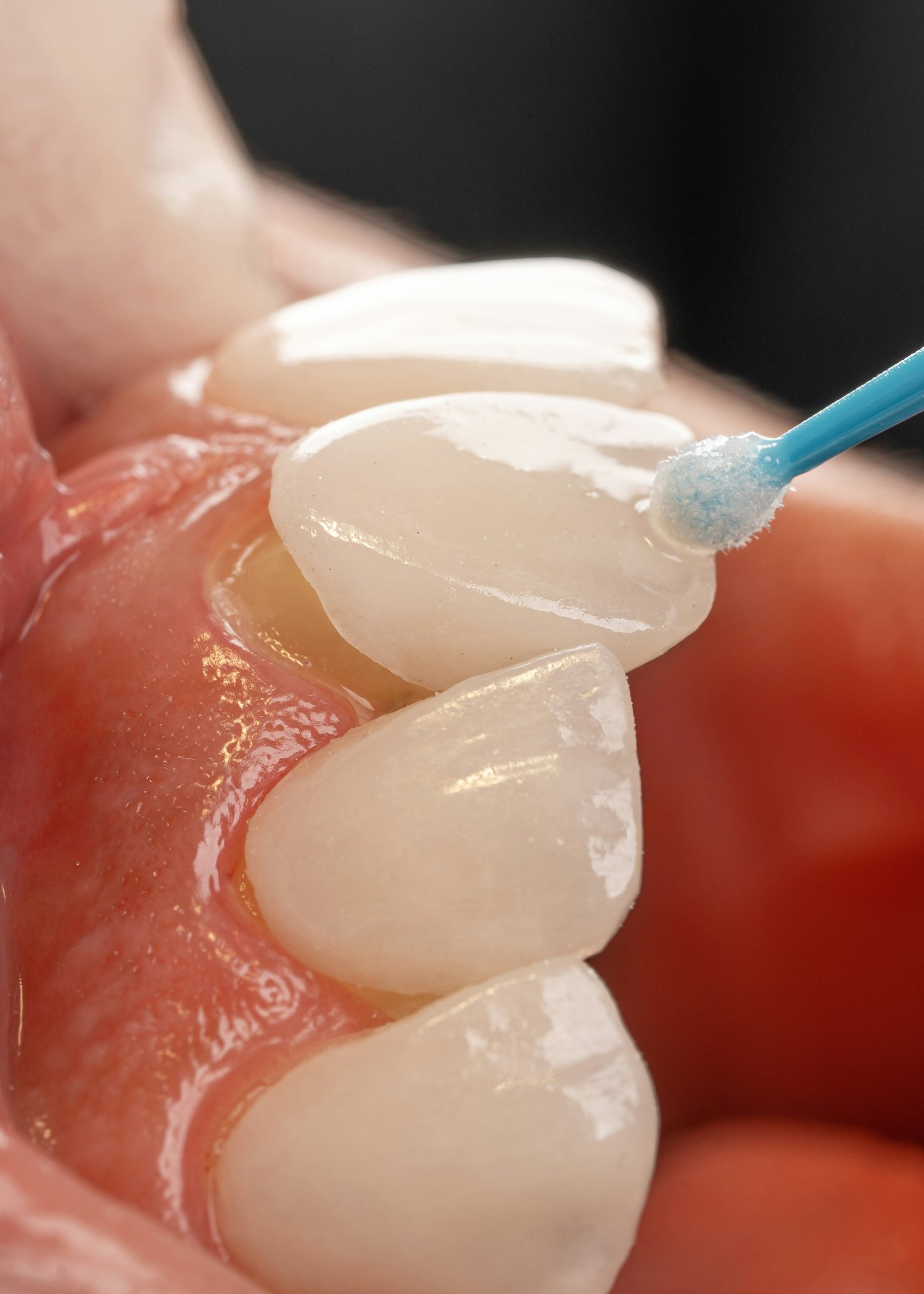 Healthy pink gums supporting clean, white teeth.

