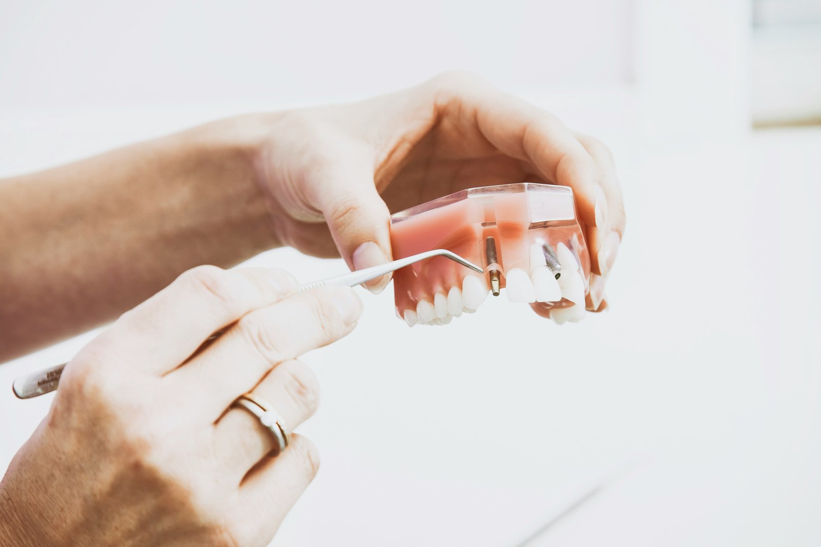 3D model of a dental bridge, illustrating how it connects to adjacent teeth to restore a smile.